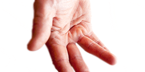 hand surgery for dupuytrens contracture
